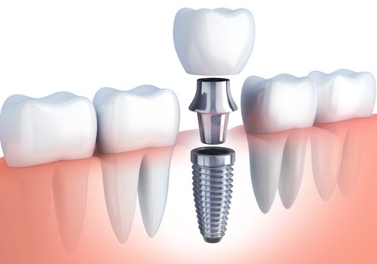 Todo lo que debes saber sobre el implante dental