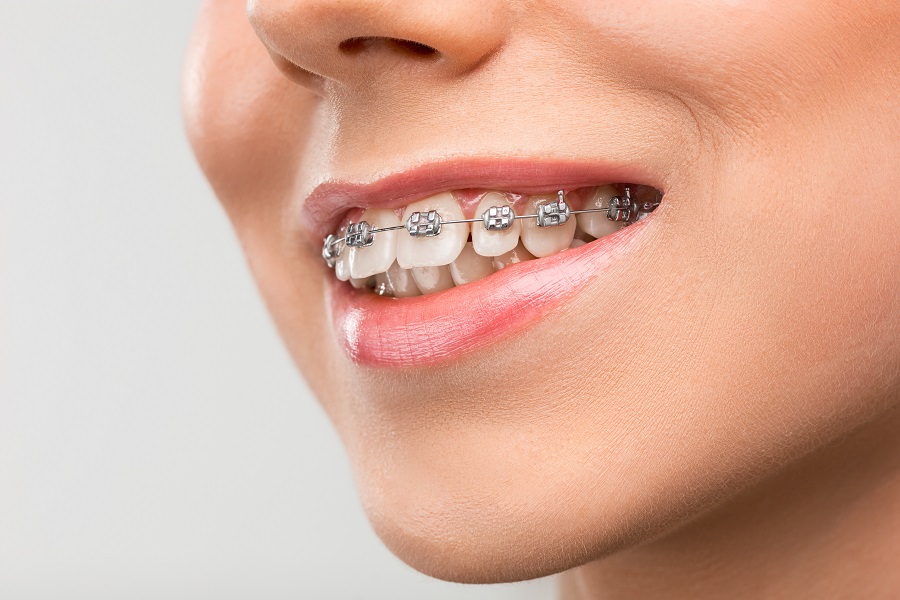 ortodoncia, que es ortodoncia, tipos de ortodoncia, tratamientos de ortodoncia