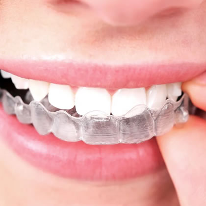 ortodoncia, que es ortodoncia, tipos de ortodoncia, tratamientos de ortodoncia